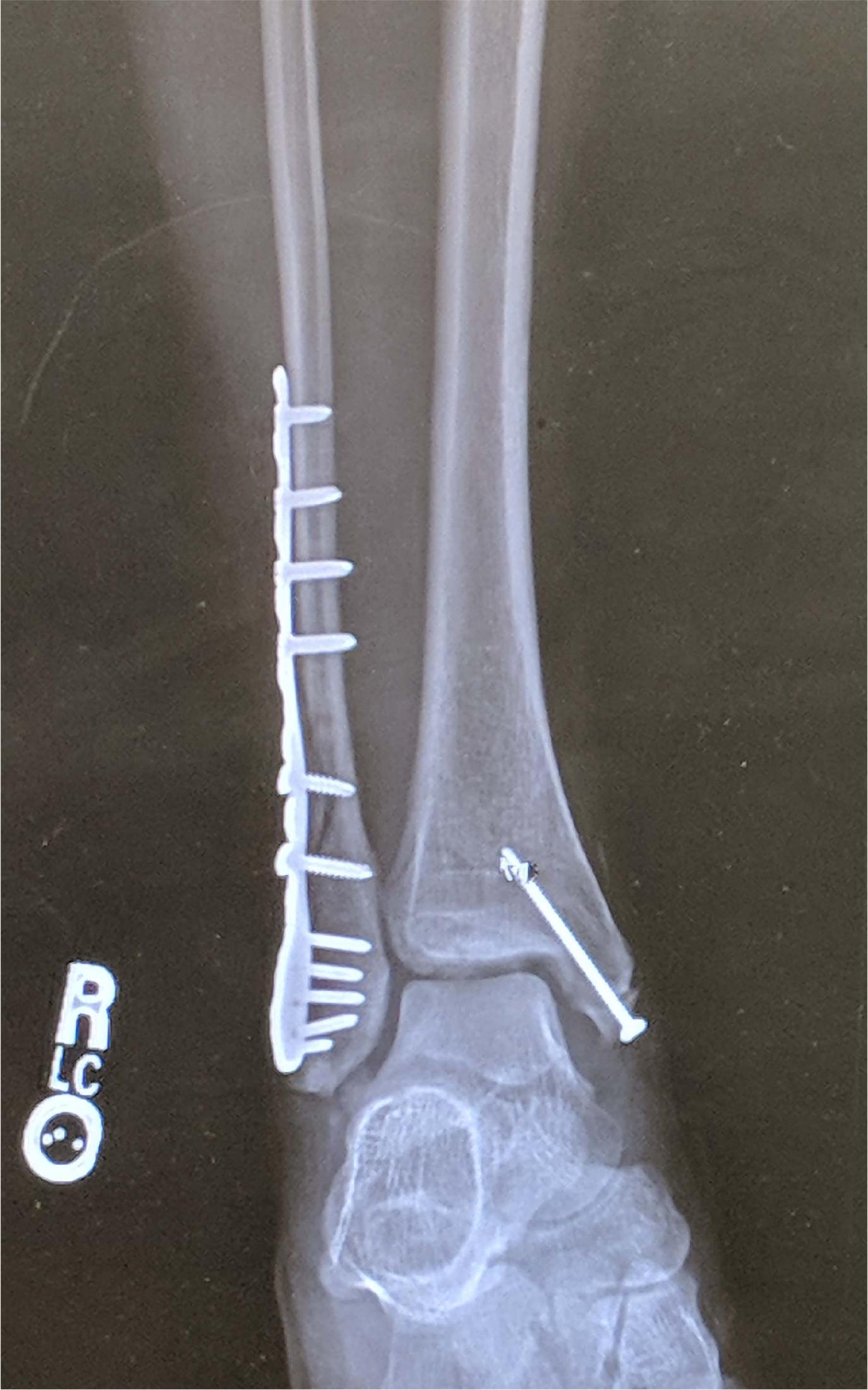 Ankle x-ray with metal hardware